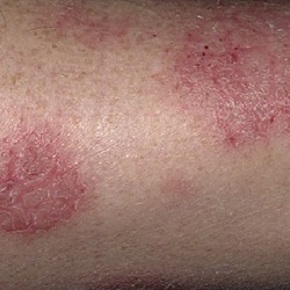 Eczema