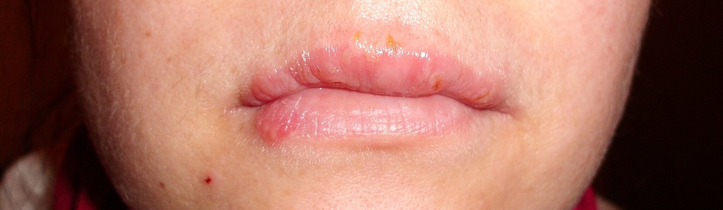 Herpes labial