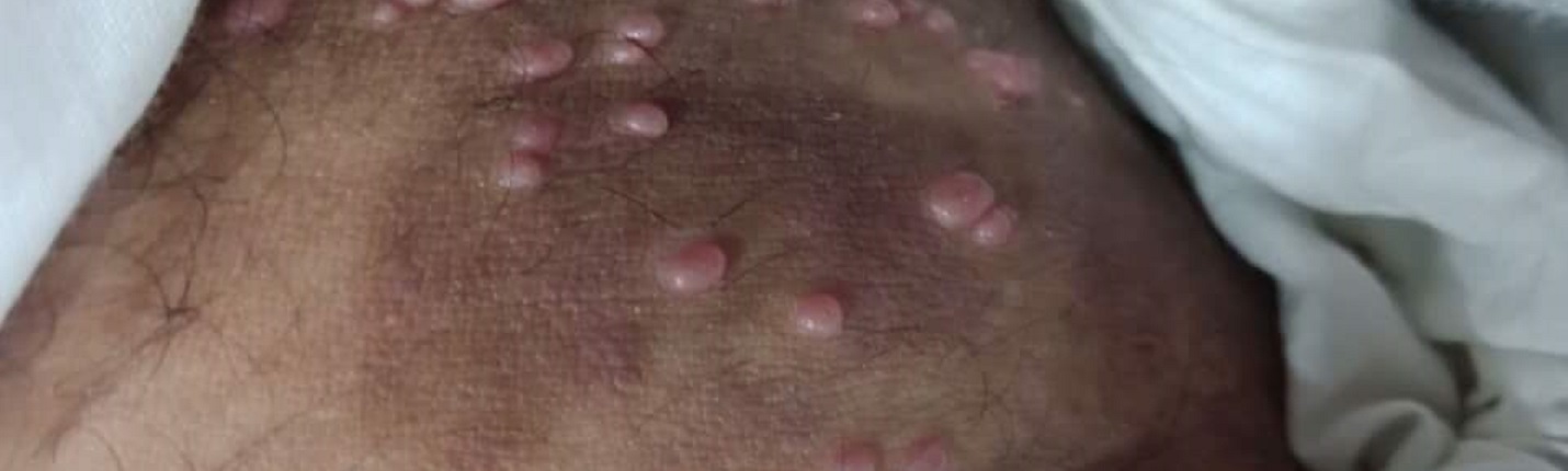 Molluscum contagiosum