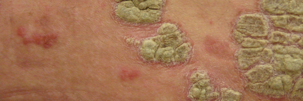 Psoriase